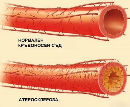 Малко е неприятно на вкус, но пък чисти мощно кръвоносните съдове и ме пази от инсулт!