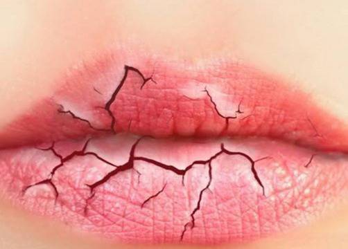 Как да се справим с напуканите устни през зимата?
