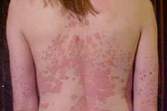 Безплатни прегледи за псориазис при кожни лекари във ВМА