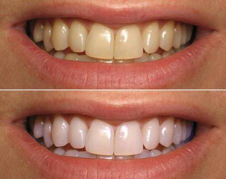 Полиране и избелване на зъби в домашни условия