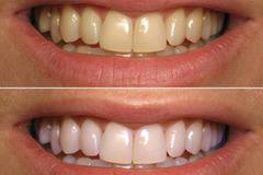 Полиране и избелване на зъби в домашни условия