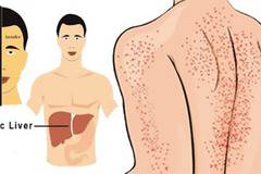 Вижте какви са симптомите, които Ви подсказват, че имате проблем с черния дроб!