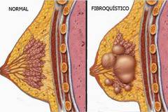 Как да се отървем от досадната киста на гърдата? Аз открих природен метод, който ги заличава напълно!