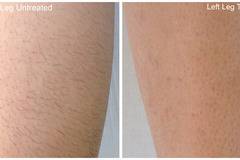 Диодна лазерна епилация