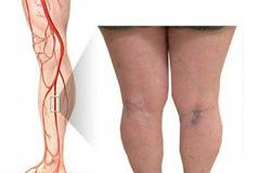 Как да се излекуваме от разширените вени с прост и лесен народен трик?