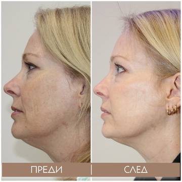 IPL фотоподмладяване – Photo Rejuvenation