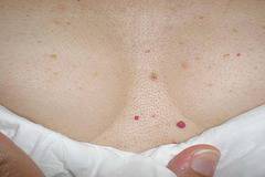 Имате ли подобни червени бенки по тялото? Вижте какво означава това!