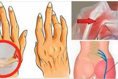 Не е нужно да купувате скъпи хапчета и мазила, за да се отървете от артрита, нужно ви е само…