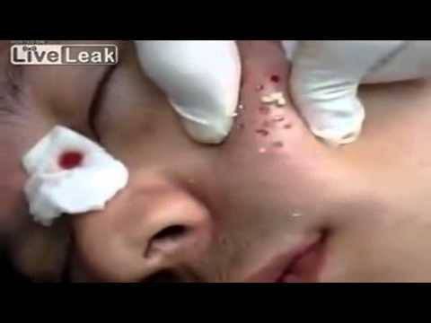 Няколко капки бира и край на гнойните пъпки по лицето и гърба!