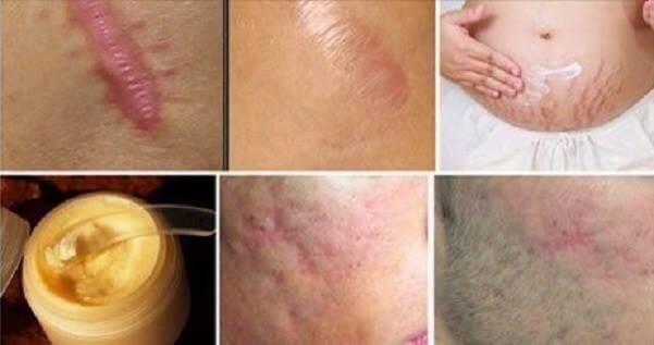 Магически мехлем премахва всякакви белези и кожни дефекти само за 2 месеца. Започнете веднага!