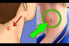 Ако имате мастни топчета по тялото, то задължително трябва да прочетете ТОВА!