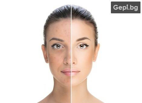 Мезотерапия на лице за премахване на пигментни петна и изравняване на тена от Milano Beauty Center!