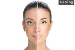 Мезотерапия на лице за премахване на пигментни петна и изравняване на тена от Milano Beauty Center!