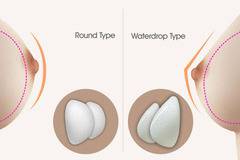 Кръгли или Анатомични силиконови импланти