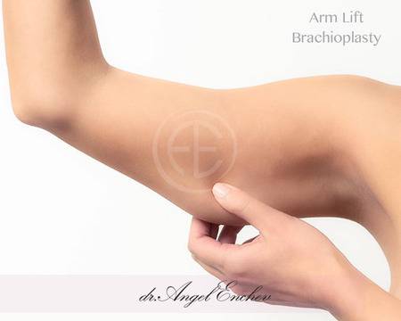 Пластика на ръце, Брахиопластика или Armlift – Пластична хирургия д-р Ангел Енчев
