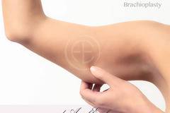 Пластика на ръце, Брахиопластика или Armlift – Пластична хирургия д-р Ангел Енчев