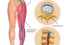 Ишиасът може да доведе до инвалидност