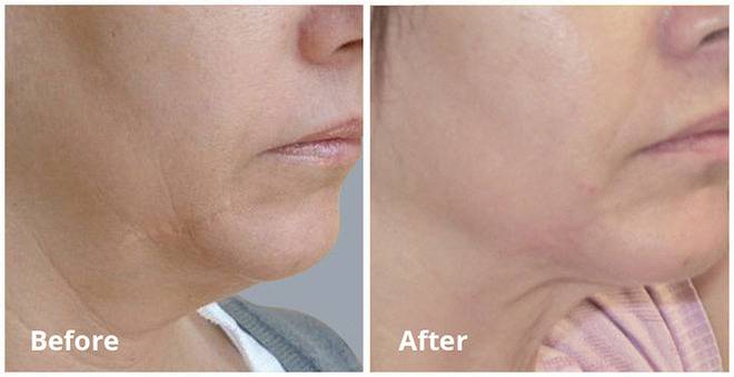 Радиочестотен лифтинг за лице