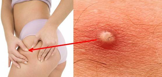 Как да се оттървем от гнойните и възпалени пъпки по тялото?