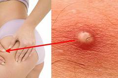 Как да се оттървем от гнойните и възпалени пъпки по тялото?