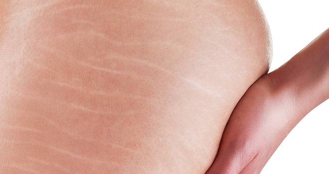 Премахване на стрии-всички начини