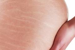 Премахване на стрии-всички начини