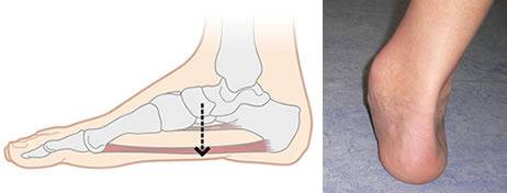 Видовете плоскостъпие и проблемите, които създават