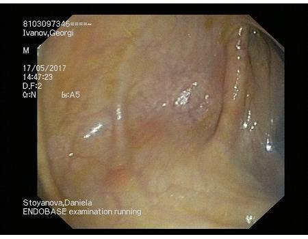 Болест на Крон и Улзерозен Колит, Част ХХХ – Продължаващи запитвания и коментарии за доказалата се вече ЗРХТ
