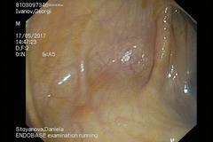 Болест на Крон и Улзерозен Колит, Част ХХХ – Продължаващи запитвания и коментарии за доказалата се вече ЗРХТ