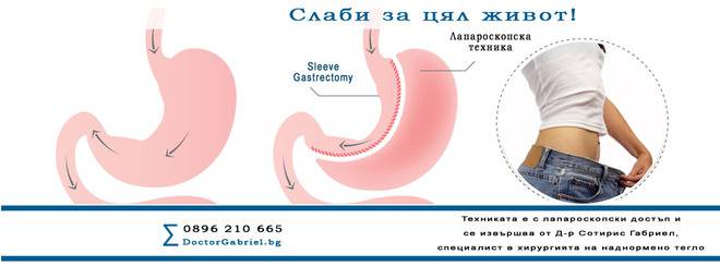 Sleeve gastrectomy е лапароскопска техника, успешно прилагана от Д-р Габриел, специалист в хирургия на наднормено тегло