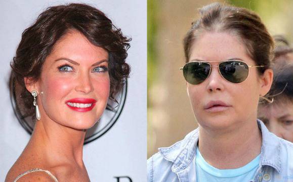 10 звезди, които провалиха кариерите си заради пластична операция