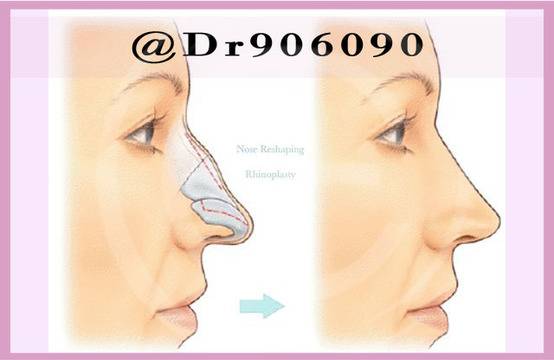 Ринопластиката подобрява Симетрията на лицевите пропорции