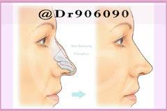 Ринопластиката подобрява Симетрията на лицевите пропорции