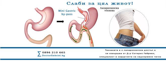 Слаби за цял живот чрез Mini Gastric by-pass! Техниката се извършва от Д-р Габриел, специалист по бариатрична хирургия