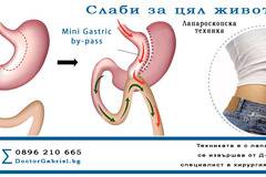 Слаби за цял живот чрез Mini Gastric by-pass! Техниката се извършва от Д-р Габриел, специалист по бариатрична хирургия