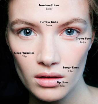 Ботокс или Филъри?