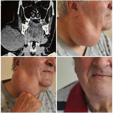 20-сантиметров тумор махнаха от шията на мъж във ВМА