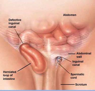 Безплатни прегледи за херния във ВМА