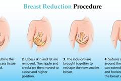 Намаляване и повдигане на гърдите, заради болки в гърба, в следствие тежестта на бюста