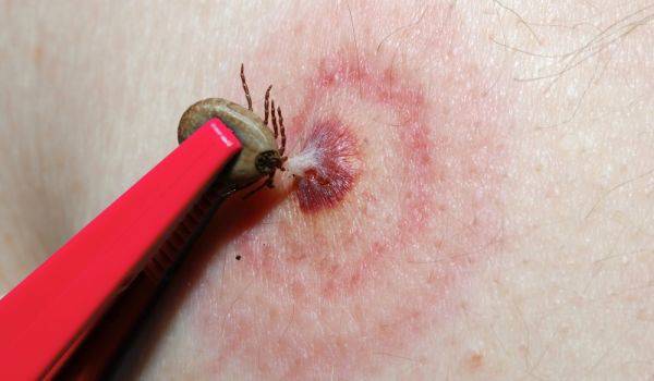 Какво да правите, ако ви ухапе кърлеж?