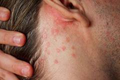 Псориазис – симптоми и диагностика