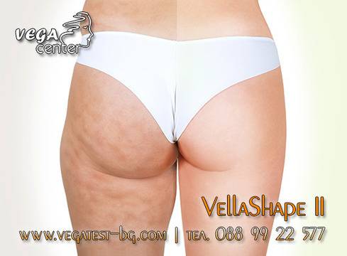 Целулит е кошмарна дума за всяка жена и дори тийнейджърите имат целулит, твърдят дерматолозите