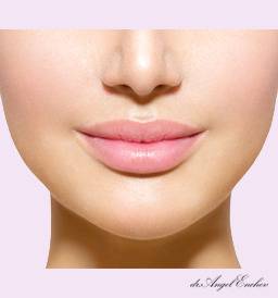 Бишектомия (Bichectomy или Bichatectomy)