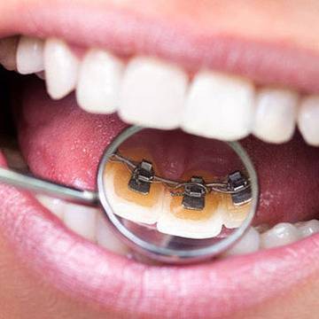 Поставяне на брекети