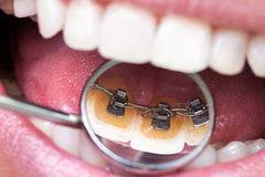 Поставяне на брекети