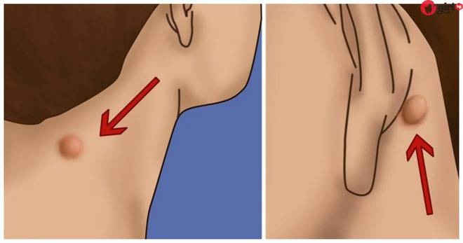 Имате ли подобно малко топченце зад ухото или на врата? Важното е да не се паникьосвате! Ето какво да направите още сега: