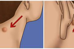 Имате ли подобно малко топченце зад ухото или на врата? Важното е да не се паникьосвате! Ето какво да направите още сега: