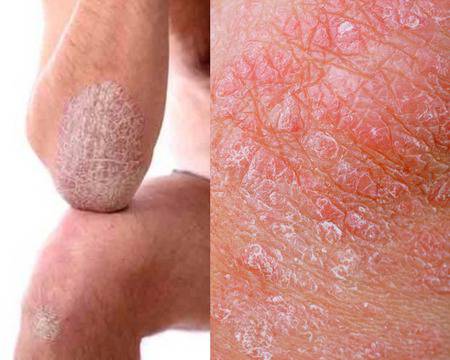 Какво Причинява Нежеланата Пигментация на Кожата и Как да Третираме Проблема ?