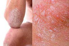 Какво Причинява Нежеланата Пигментация на Кожата и Как да Третираме Проблема ?