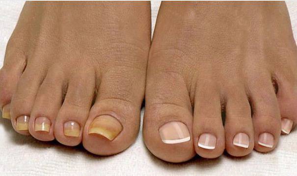 3 народни трика, с които да премахнете завинаги досадните гъбички на краката!